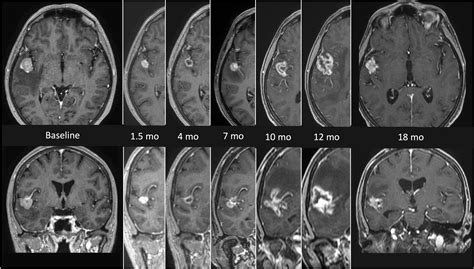 Frontiers | Modern Radiation Therapy for the Management of Brain Metastases From Non-Small Cell ...