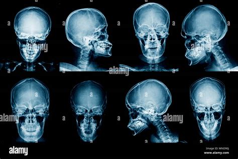 X Ray Of Human Skull