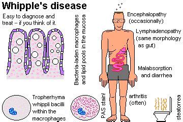 Whipple | Whipple's disease, Medical surgical nursing, Medicine studies