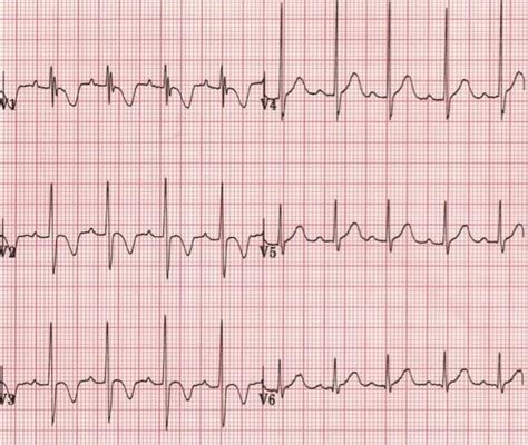 R On T Wave ECG