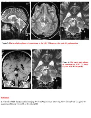 Short case...tectal plate glioma | PDF