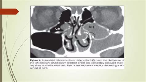 Surgical anatomy of osteomeatal complex | PPT