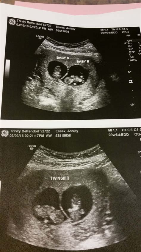 What Does A Ultrasound Look Like With Twins at Leslie Baptist blog