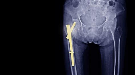 Hitting the Nail on the Head? Evolution of the cephalomedullary nail in ...