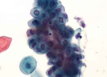 Atypical Urothelial Cells Indeterminate for Neoplasia - Urothelial Cells