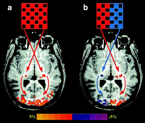 Lateral Geniculate Nucleus Mri