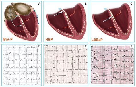 Frontiers | Success rates, challenges and troubleshooting of left bundle branch area pacing as a ...