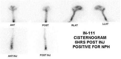 Cisternogram | Cedars-Sinai