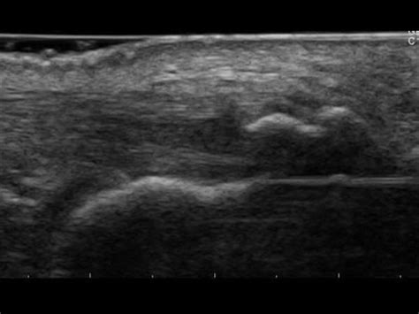 Musculoskeletal Joints and Tendons | 6.7 Ankle : Case 6.7.6 Achilles ...