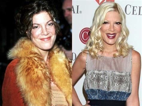 Tori Spelling before and after plastic surgery 05 – Celebrity plastic ...