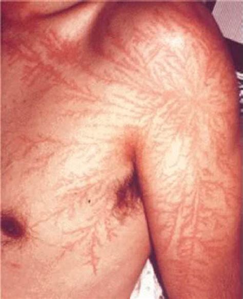 Lichtenberg Figures: The Fractal Patterns of Lightning Strike Scars » TwistedSifter