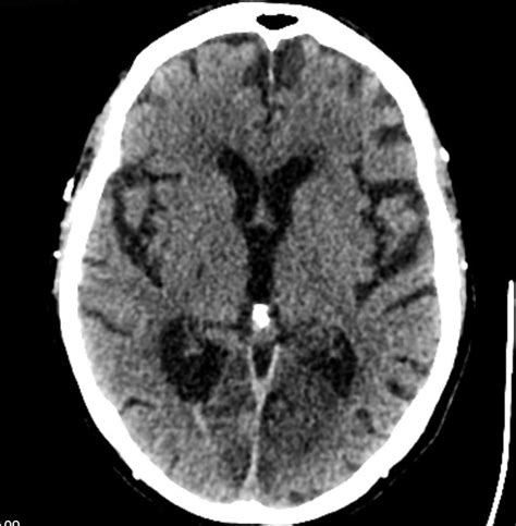 Anton’s syndrome: a rare and unusual form of blindness | BMJ Case Reports