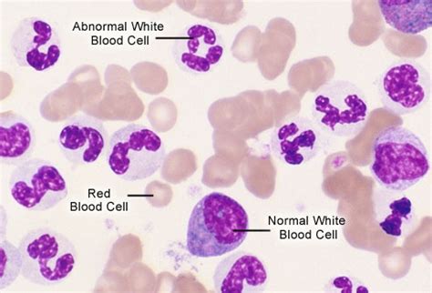 chronic myeloid leukemia | Medical Laboratories