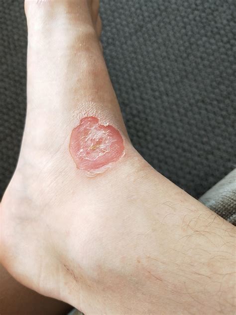 I got a huge blister on my foot that's infected with staph (I have been to the pharmacy and ...