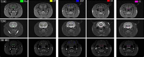 Frontiers | Evidence for Dopamine Abnormalities Following Acute Methamphetamine Exposure ...