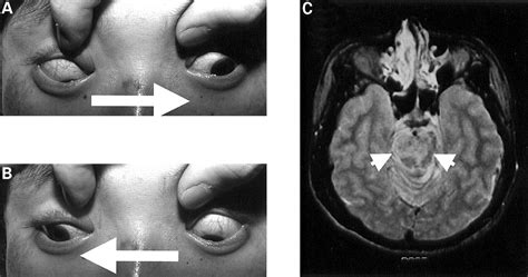 Disconjugate vertical ocular movement in a patient with locked-in ...