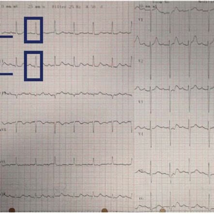 Evaluation of electrocardiographic P wave parameters in predicting long-term atrial fibrillation ...