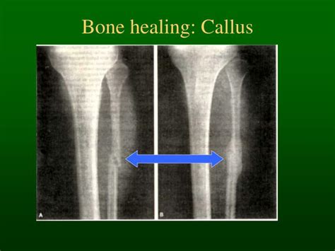 PPT - Bone Histology & Fracture Healing PowerPoint Presentation - ID ...