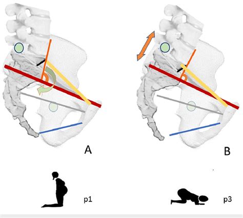 Pelvic anteroposterior diameters in shifting positions. A, p1 ...