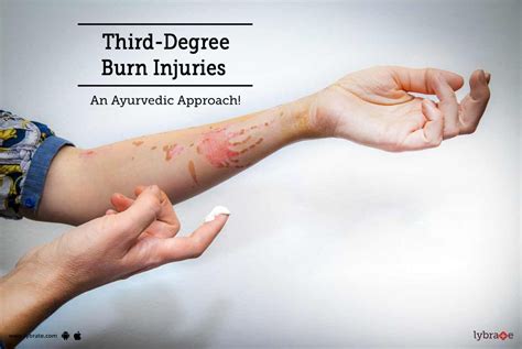 Third-Degree Burn Injuries - An Ayurvedic Approach! - By Dr. Sumit ...