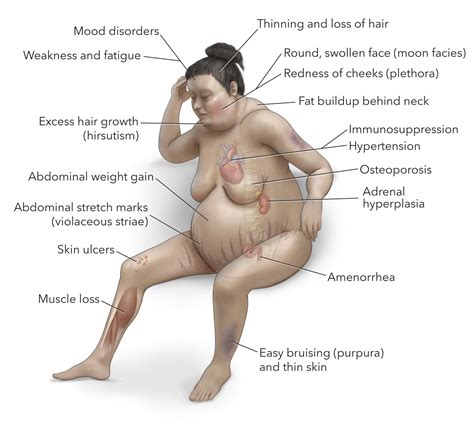 Unveiling Cushing's Syndrome: Understanding Its Causes and Effects - HEMLOCK