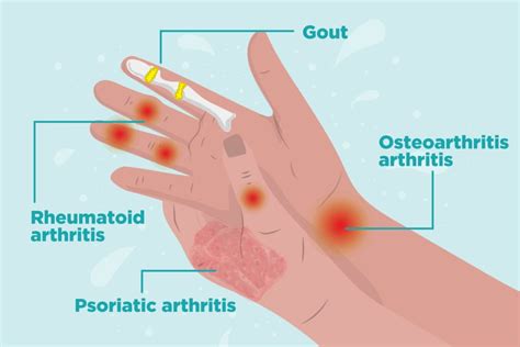 Arthritis in Hands: Symptoms, Types of Hand Arthritis, and Treatment