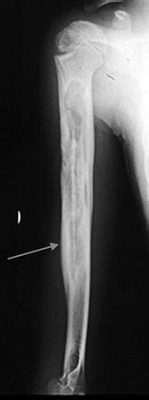 Osteomyelitis - Adult - Trauma - Orthobullets