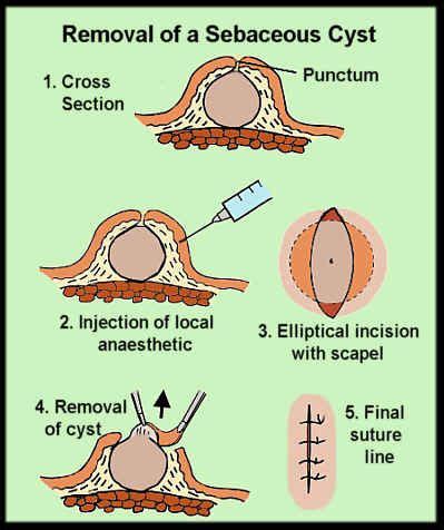 Video Epidermal Sebaceous Cyst Drainage From The