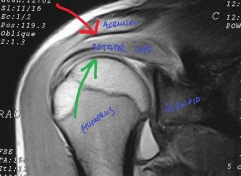 Shoulder Impingement - 3 Keys to Assessment and Treatment