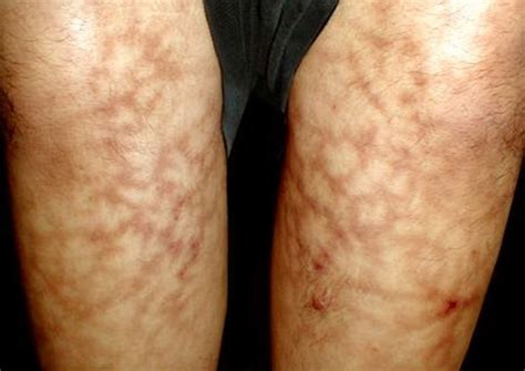 Symptomatic Livedo Reticularis (Livedo Racemosa): Causes, Symptoms and Treatment