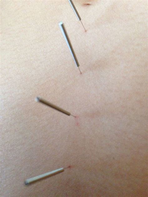 Self-Acupuncture for Stomach Health | Traditional medicine, Naturopathic medicine, Health