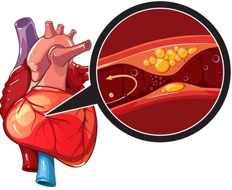 Coronary Artery Disease Cardiovascular | Images and Photos finder