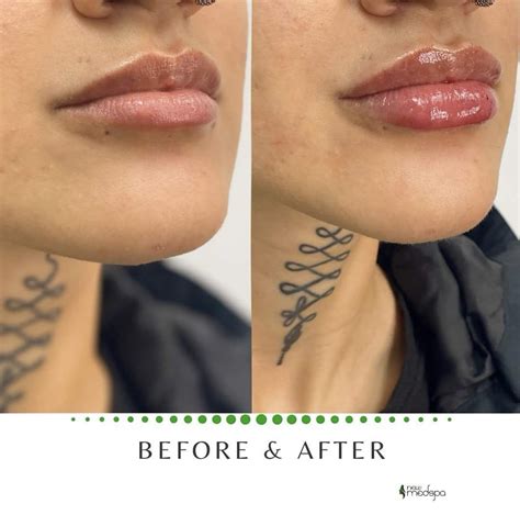 Lip filler before after west em medical spa – Artofit