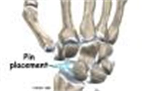 Wrist Ligament Injuries | eOrthopod.com
