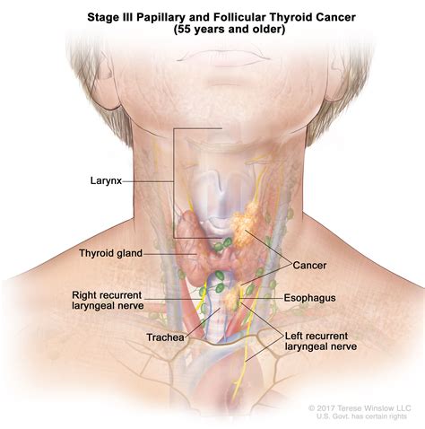 Thyroid Cancer Treatment (Adult) (PDQ®)–Health Professional Version ...