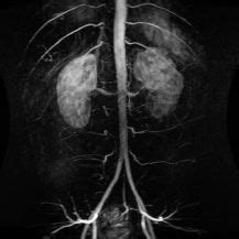 Abdominal aortogram with runoff cpt code