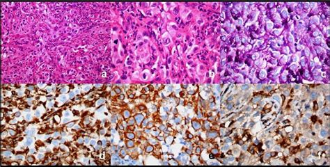 Figures a-f: Photomicrograph demonstrates sheets of polygonal cells... | Download Scientific Diagram