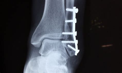 Orthopedic surgery advances: The screw that dissolves