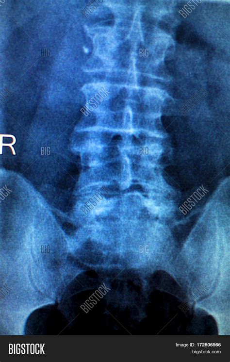 Spine Hips Xray Test Image & Photo (Free Trial) | Bigstock