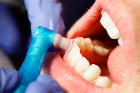 Effects of Polishing on Restorations - Dimensions of Dental Hygiene