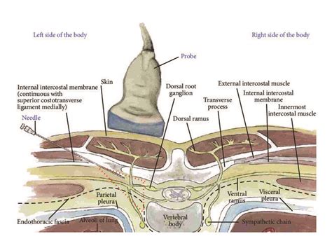 Procedure for paravertebral hydrodissection: cross-sectional anatomy.... | Download Scientific ...