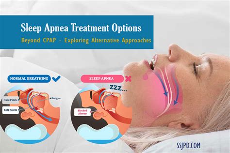 Sleep Apnea Treatment Options: Beyond CPAP - Exploring Alternative Approaches - SS Publishers ...