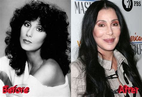 Cher Plastic Surgery : Just Too Much Of Procedures