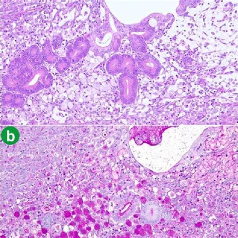 Both signet-ring cells and adenocarcinoma cells stained positively for... | Download Scientific ...