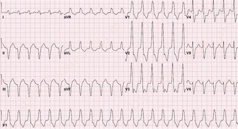 Monomorphic Sustained Ventricular Tachycardia ECG (Example 3) | Learn the Heart