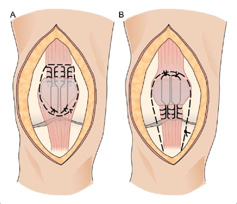 Quadriceps Tendonitis Brace