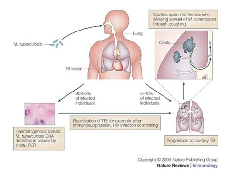 Tuberculosis 2: Pathophysiology and microbiology of pulmonary tuberculosis