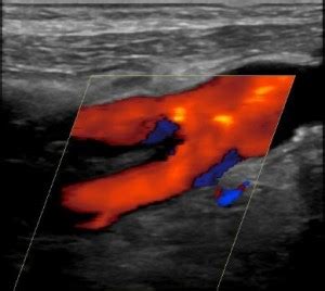 Carotid artery imaging. How to choose the right study