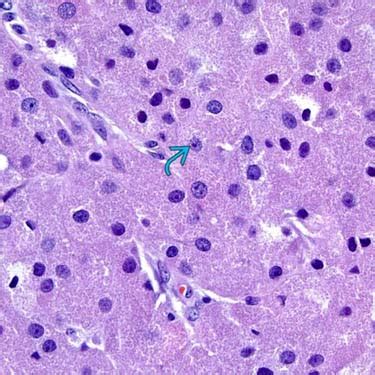 Granular Cell Tumor | Basicmedical Key