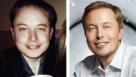 Elon Musk Hair Transplant: Everything You Need To Know